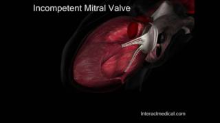 Mitral Valve, normal and incompetent