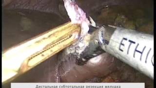 Лечение рака желудка (Дистальная субтотальная резекция желудка)