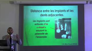 5ème commandement dentaire: les règles de positionnement de l'implant