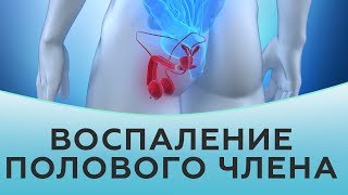 Воспаление полового члена