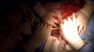 penis kanseri-parsiyel penektomi / penile cancer-parsial penectomy www.penilcerrahi.com