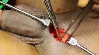 Penis enlargement