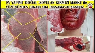 İLK UYGULAMADA LEKELERİ,İZLERİ ,TÜYLERİ SÖKÜP ATAN, EV YAPIMI -DOĞAL -SOYULAN KIRMIZI MASKE