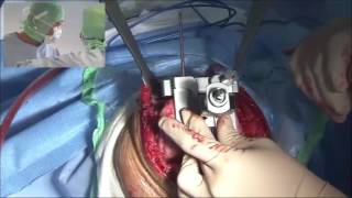 Prothèse totale de genou - Dr H.Silbert
