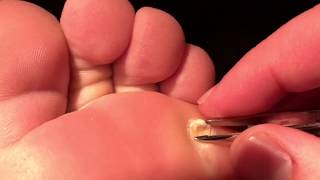 Day 82: My Plantar Wart is Gone! I Dig Out the Rest. Enjoy!