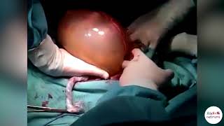 Amazing triplet birth