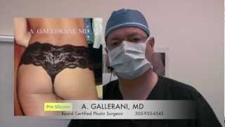 Silicone Butt Disasters
