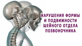 Нарушения формы и подвижности шейного отдела позвоночника