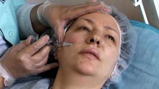 Мастер-класс "Коррекция различных анатомических зон монофазным гиалуроновым филлером Regenyal Idea"