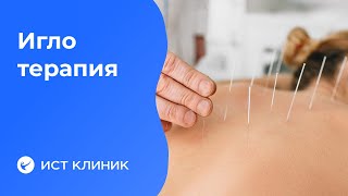Иглотерапия (китайское иглоукалывание,  иглорефлексотерапия, акупунктура). [видео]