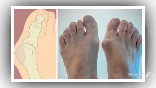 начала болеть косточка на ноге

  - valgus pro применение