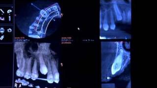 Evaluation of an Impacted Cuspid Using the CS 9300 from Carestream Dental