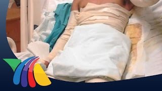 Recuperación de quemado por gasolina | Noticias de Zacatecas