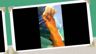 הבוהן הקלובה, הלוקס וולוגוס בטכניקה Percutaneous Bosch