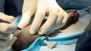 Penile Implant Surgery; Customized Technique, by Dr. Bruce B. Garber,  www.garber-online.com