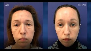 Блефаропластика нижних век и эндоскопический лифтинг бровей