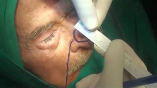 nasolabial island flap for nasal skin reconstruction