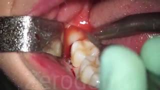 Wisdom tooth ectraction