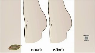 หมอเตือนฉีดอวัยวะเพศหญิง 3 มิติให้โหนกนูน ระวังติดเชื้อ ยันปล่อยเป็นตามธรรมชาติดีสุด