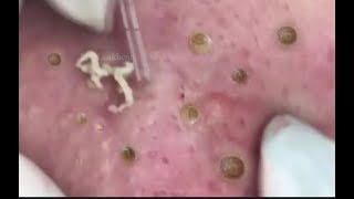 Milia how to removed deep blackheads from face and music