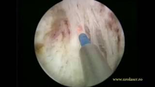 HoLEP for a large prostate
