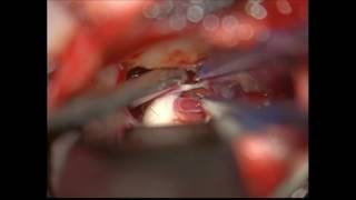Trigeminal Neuralgia Surgery video