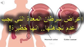 أعراض سرطان المعدة التي يجب عدم تجاهلها   إنها خطيرة!