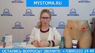 Как пользоваться кольцами для стомы Стомагезив Сил от КонваТек видеоинструкция