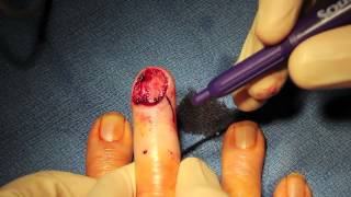 Live Surgery. Completion of Distal Finger Amputation for Cancer.m4v