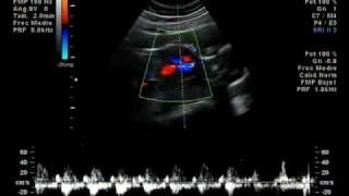 Es niña!!, se llamara Ximena, 19 Semanas de Gestacion