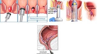 Быстро избавиться от геморроя – лечение геморроя лигированием