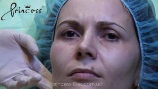 Коррекция периорбитальной зоны препаратом Princess Filler (Croma, Австрия)