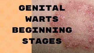 Genital Warts Beginning Stages