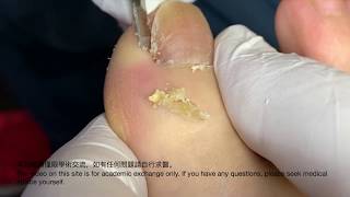 甲溝炎-paronychia 베트남/realxing video 241/涷甲/嵌甲/Ingrown nail treatment（how to fix ingrown toenail）