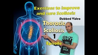 Thoracic scoliosis  treatment Episode 1