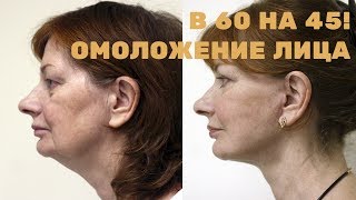 Омоложение лица – в 60 выглядеть на 45!