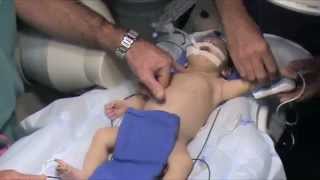 HLHS: Retrograde aortic arch stenting with bypass support after Hybrid Stage 1 Palliation