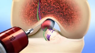 Bridge-Enhanced ACL Repair (BEAR) | Boston Children's Hospital