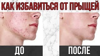 КАК ИЗБАВИТЬСЯ ОТ ПРЫЩЕЙ ? | КАК ИЗБАВИТЬСЯ ОТ АКНЕ ? | ЛАЙФХАКИ ОТ ПРЫЩЕЙ