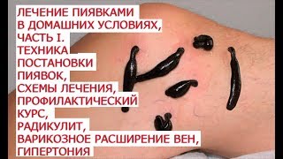 Лечение пиявками в домашних условиях, часть I  Техника постановки пиявок, схемы лечения