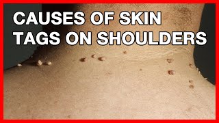 Causes of Skin Tag on Face, Shoulders, Armpits and Neck