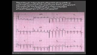 ეკგ / მარცხენა პარკუჭის გავრცელებული დაზიანება / მარცხენაპარკუჭოვანი უკმარისობა / marcxena parkuchi