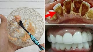 2 MENIT AJA, GIGI KUNING KARANG GIGI RONTK, CARA CEPAT MEMUTIHKAN GIGI DAN MENGHILANGKAN KARANG GIGI