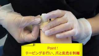巻き爪（陥入爪）の切り方　出直し看護塾　on the web