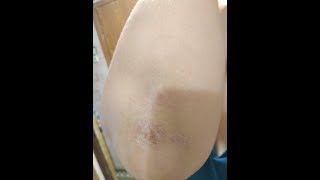 Кожа на локтях сухая и шелушится: чем помочь?