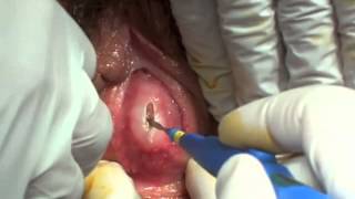Imperforate hymen with late repair