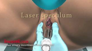 New IntimaLase Vagina Tightening Laser MD Cosmedical Solutions PH 1300885808