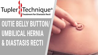 Outie Belly Button/umbilical hernia and Diastasis Recti- Julie Tupler, RN