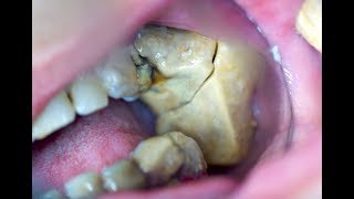หินปูน อย่าสะสม ขูดหินปูน (Dental teeth cleaning)