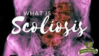 What is Scoliosis?  |  Kinetic Kids, Inc. [Pediatric Physical Therapy]
